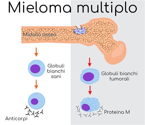 mieloma multiplos|mieloma multiplo sintomi.